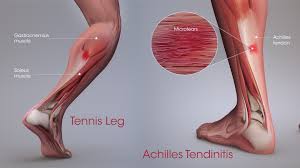 Both are made of collagen. Tennis Leg And Achilles Tendonitis Confusing The Two Can Be Dangerous