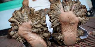 Tree man syndrome is thought to result from a genetic inability to fight off human papilloma virus (hpv). Tree Man Syndrome Bangladeshi Girl May Be First Female With Rare Disease Tech Times