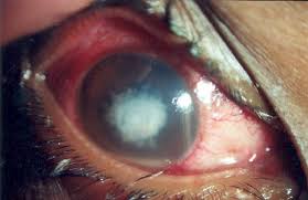 fungal infections of the cornea eye