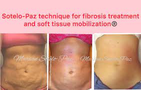 fibrosis treatment how to get rid of