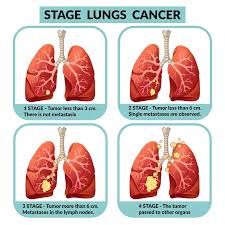 If you have lung cancer, you may be unsure about exercise. Lung Cancer Symptoms Causes Treatment Narayana Health