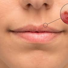 lippenherpes behandlung diagnose
