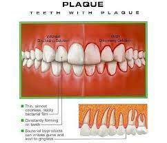 how to get rid of plaque