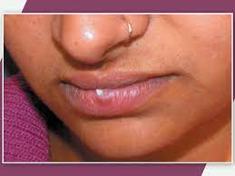 white ps or fordyce spots on lips