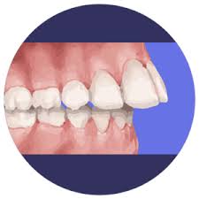 This can result in gum recession, which is when the gum tissue wears away and exposes. Adult Overjet What It Is And How To Correct It Smile Prep