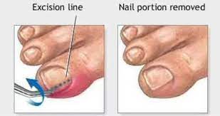 ingrown toenail removal treatment