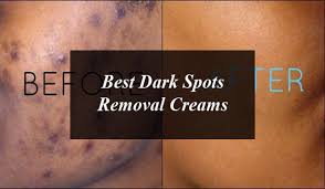 Black spot face removal cream options on alibaba.com. 4 Best Dark Spots Removal Creams In Pakistan