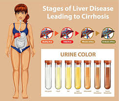 ses of liver disease organs person