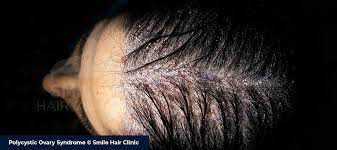 polycystic ovary syndrome pcos hair