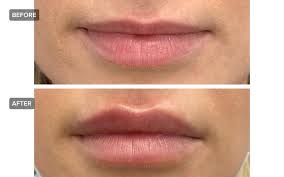 what are lip fillers and how long do