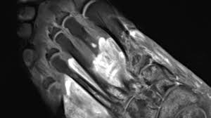 Mri with hardware in foot? Radiological Images Confirm Covid 19 Can Cause The Body To Attack Itself Northwestern Now