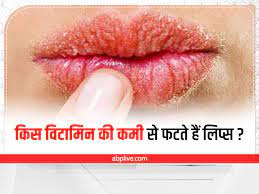 vitamin deficiency causes dry lips
