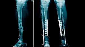 tibia fibula fracture rehab protocol