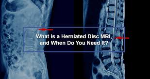 what is a herniated disc mri and when