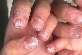 gel polishes leaking into the skin