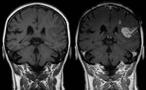mri with and without contrast explained