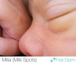 milia baby acne