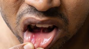 7 ways to get rid of canker sores for
