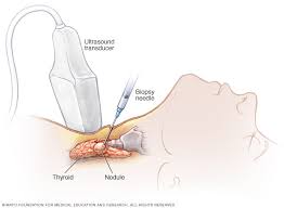 This accounts for about 10% of thyroid cancers. Thyroid Cancer Diagnosis And Treatment Mayo Clinic