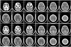 An Effective Therapy Combination for Treating Medulloblastoma in Children