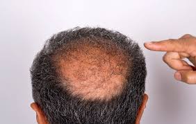 what men should do when hair loss