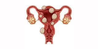 fibroid tumors and the bladder a