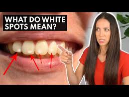 what are white spots on teeth telling