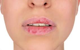 eczema on lips 8 trusted treatments