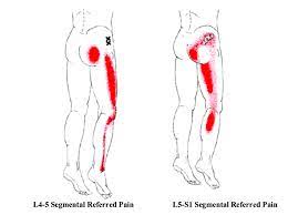 diagnosing lateral thigh pain it band