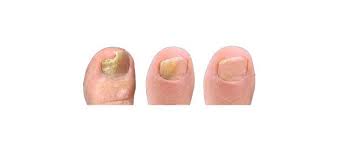 fungal nails or fungal nails treatment