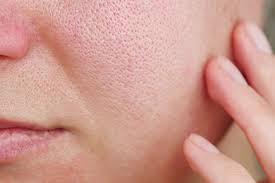 how to cure redness on face 6 home