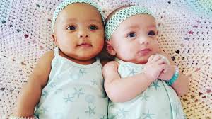these twin baby s have diffe