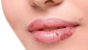 cold sores treatment herpes