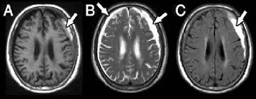 Rt burr hole craniotomy with evacuation of the hygroma was done. An Mri Of The Brain Demonstrating The Subdural Hygroma On The Right Download Scientific Diagram