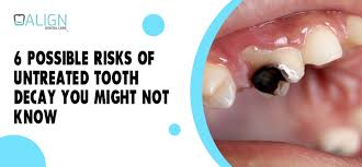 6 possible risks of rotten teeth