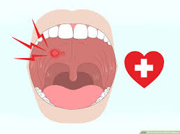 3 ways to get rid of mouth blisters