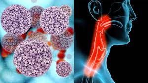 In later stage it may grow out irregular, often still ulcer like, sometimes bulky. 5 Things To Know About Hpv Related Throat Cancer Everyday Health