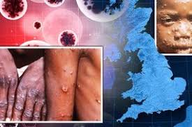 The virus was first discovered in monkeys (hence the name) in 1958, and in humans in 1970. Monkeypox Uk Where Has Monkeypox Been Found In Uk Is It Dangerous Express Co Uk