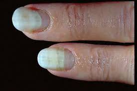 onycholysis nail problem nail fungus