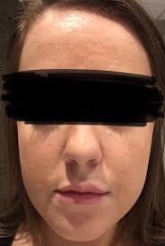 procedure to make a long face shorter