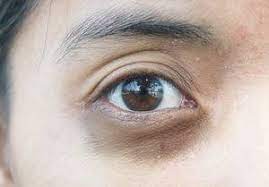 treat hyperpigmentation around the eyes