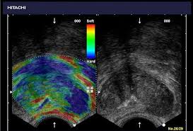 Color Flow Doppler Ultrasound Prostate Technology