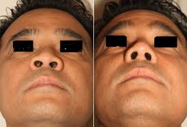 asian plastic surgery plastic surgery
