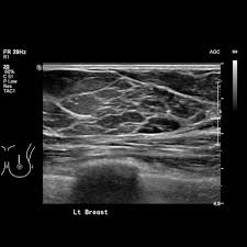 Discusses the benefits and risks of choosing more testing after that's because dense tissue looks white onscreen, just like cancer does. Breast Ultrasound Radiology Reference Article Radiopaedia Org