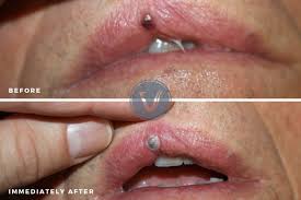 lip vein venous lake treatment the