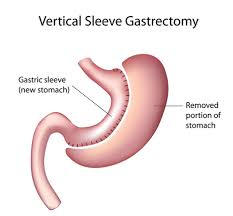 laparoscopic sleeve gastrectomy dr