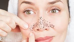 home remes for blackheads