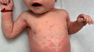 baby psoriasis appearance diagnosis