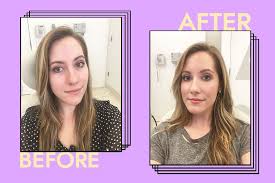 i got restylane fillers for the first time