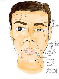 cureus bell s palsy a review article